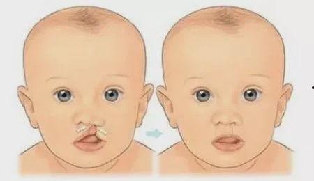 宝宝腭裂图片,揭示这一罕见面部畸形的真实面貌