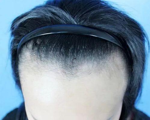 网红纹了发际线的图片,纹发际线术，重塑颜值新高度